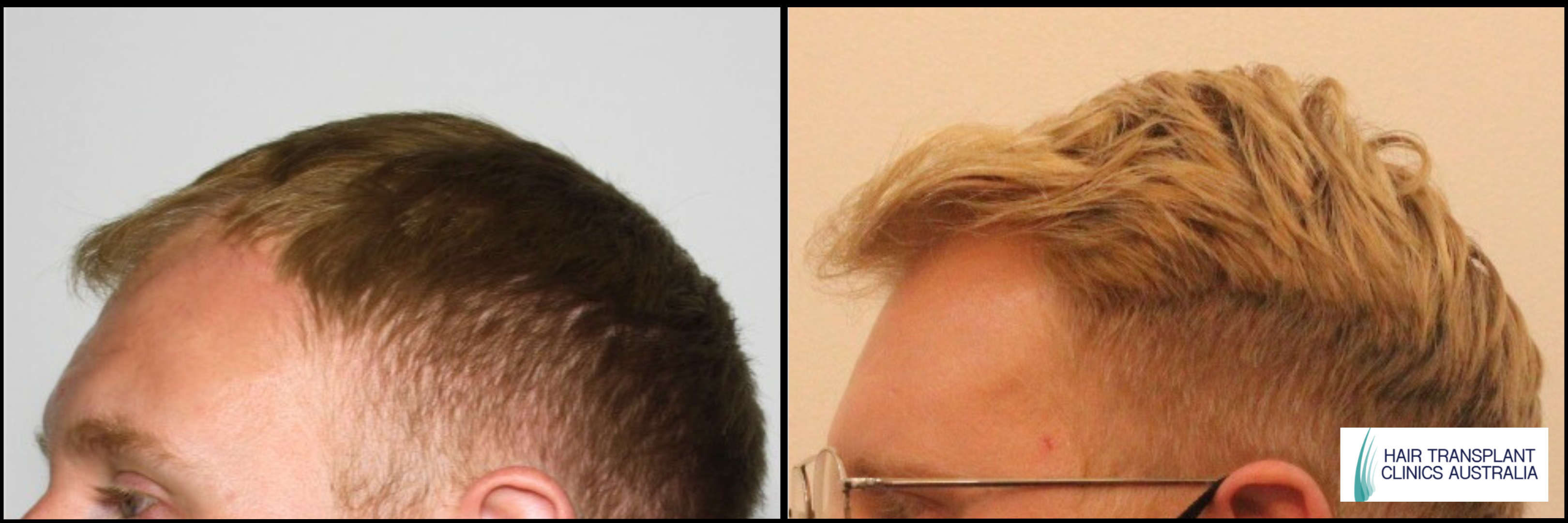 Scalp FUE Before & After Image